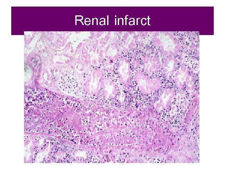 Renal infarct 