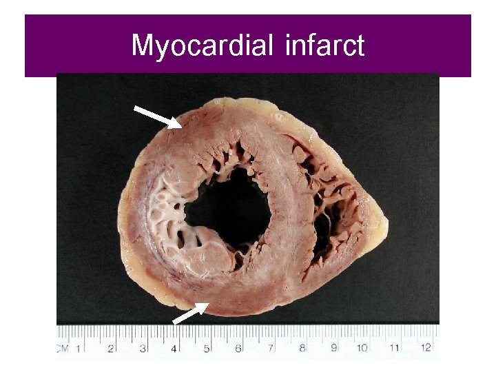 Myocardial infarct 