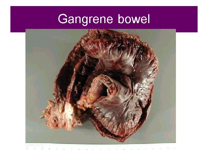 Gangrene bowel 