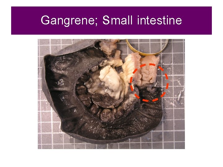 Gangrene; Small intestine 