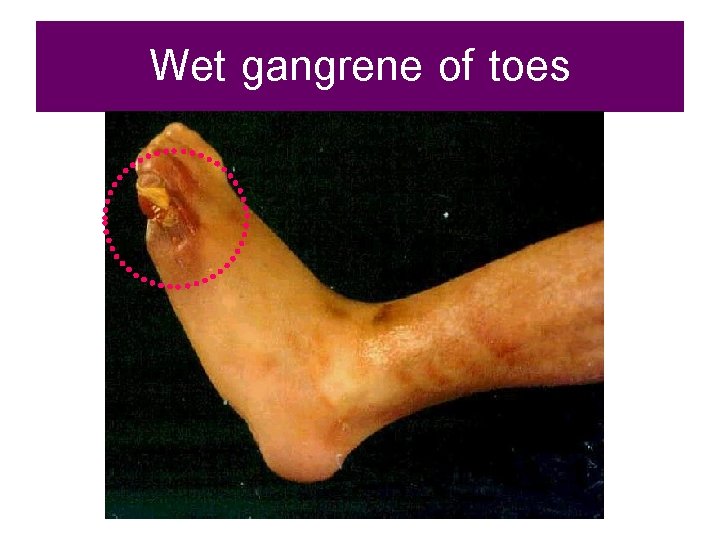 Wet gangrene of toes 