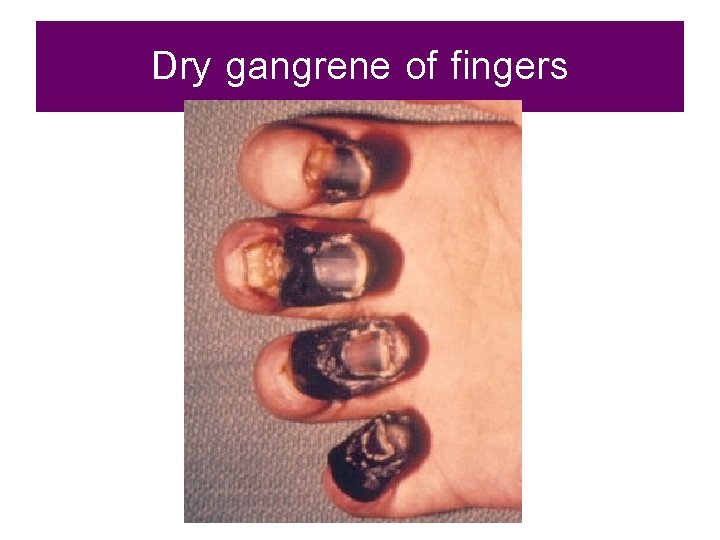 Dry gangrene of fingers 
