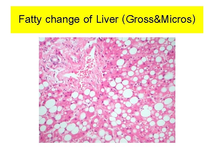 Fatty change of Liver (Gross&Micros) 