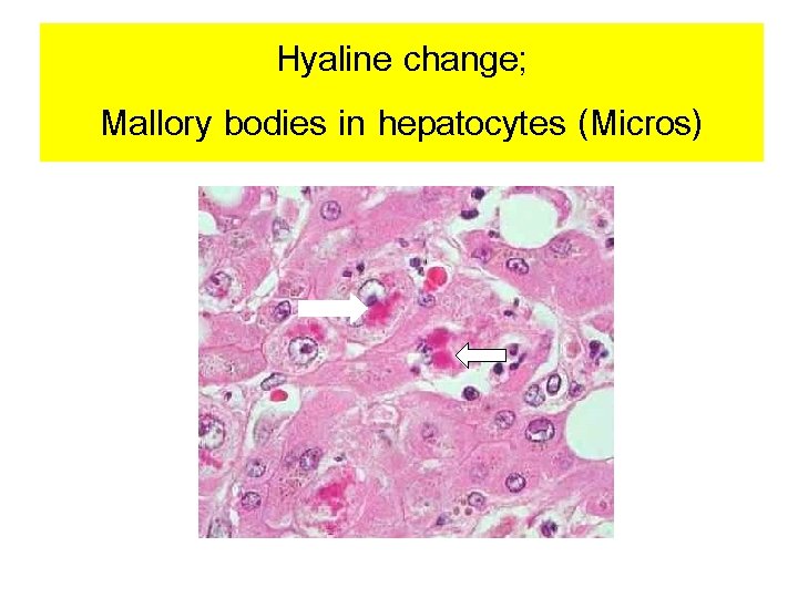 Hyaline change; Mallory bodies in hepatocytes (Micros) 