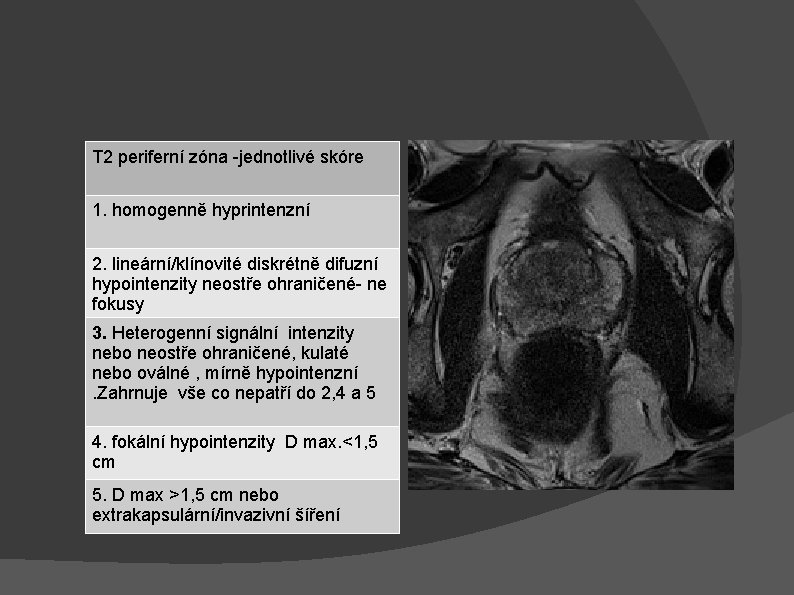 T 2 periferní zóna -jednotlivé skóre 1. homogenně hyprintenzní 2. lineární/klínovité diskrétně difuzní hypointenzity