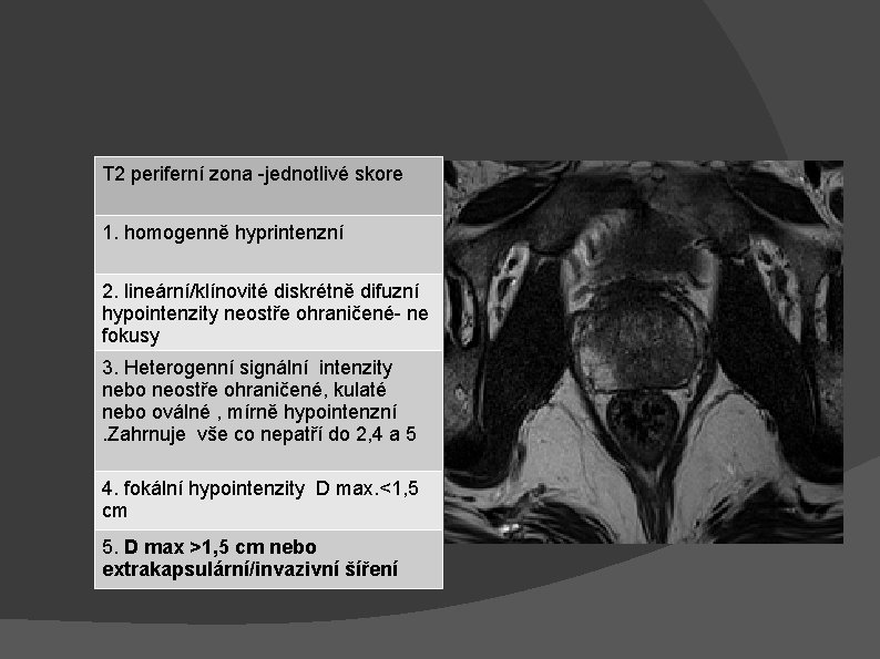 T 2 periferní zona -jednotlivé skore 1. homogenně hyprintenzní 2. lineární/klínovité diskrétně difuzní hypointenzity