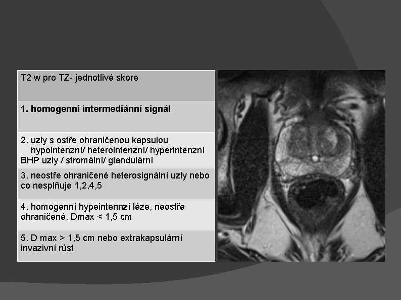 T 2 w pro TZ- jednotlivé skore 1. homogenní intermediánní signál 2. uzly s