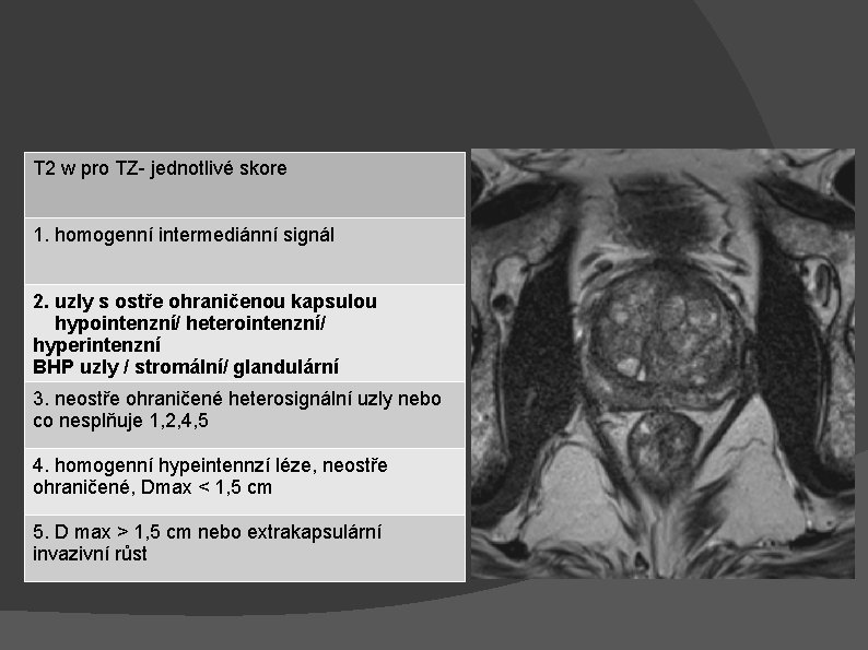 T 2 w pro TZ- jednotlivé skore 1. homogenní intermediánní signál 2. uzly s