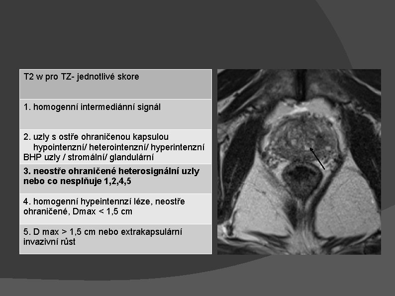 T 2 w pro TZ- jednotlivé skore 1. homogenní intermediánní signál 2. uzly s