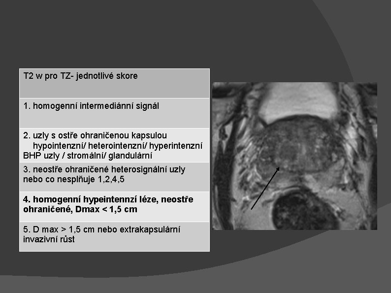 T 2 w pro TZ- jednotlivé skore 1. homogenní intermediánní signál 2. uzly s