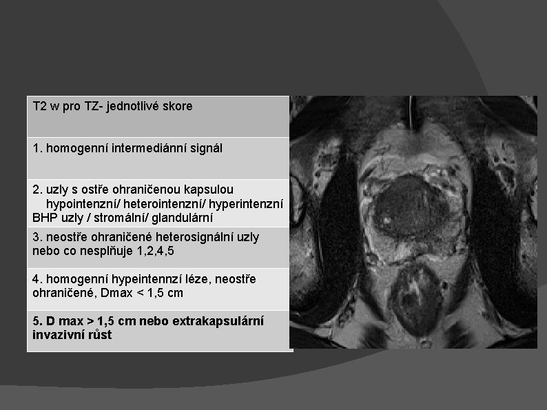 T 2 w pro TZ- jednotlivé skore 1. homogenní intermediánní signál 2. uzly s