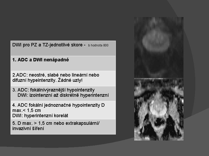 DWI pro PZ a TZ-jednotlivé skore - b hodnota 800 1. ADC a DWI