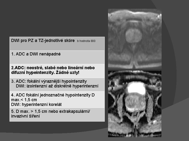 DWI pro PZ a TZ-jednotlivé skóre b hodnota 800 1. ADC a DWI nenápadné