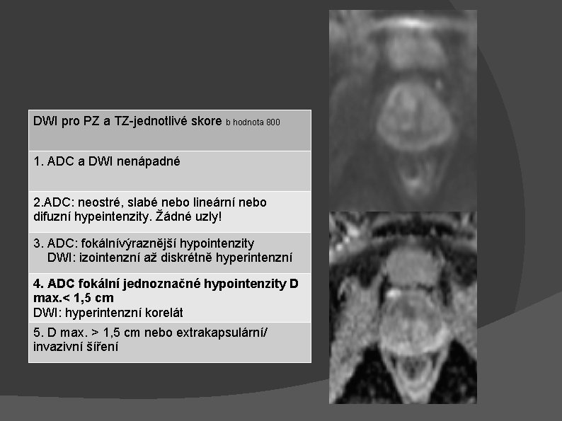 DWI pro PZ a TZ-jednotlivé skore b hodnota 800 1. ADC a DWI nenápadné