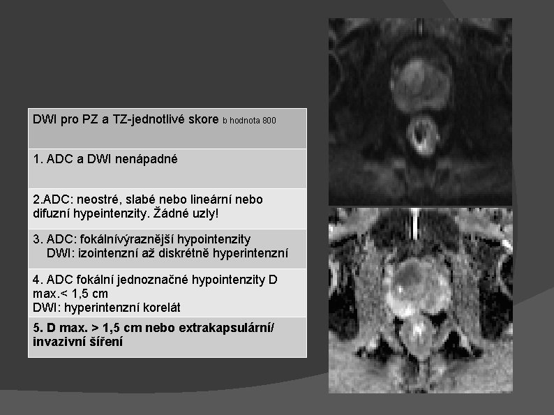 DWI pro PZ a TZ-jednotlivé skore b hodnota 800 1. ADC a DWI nenápadné