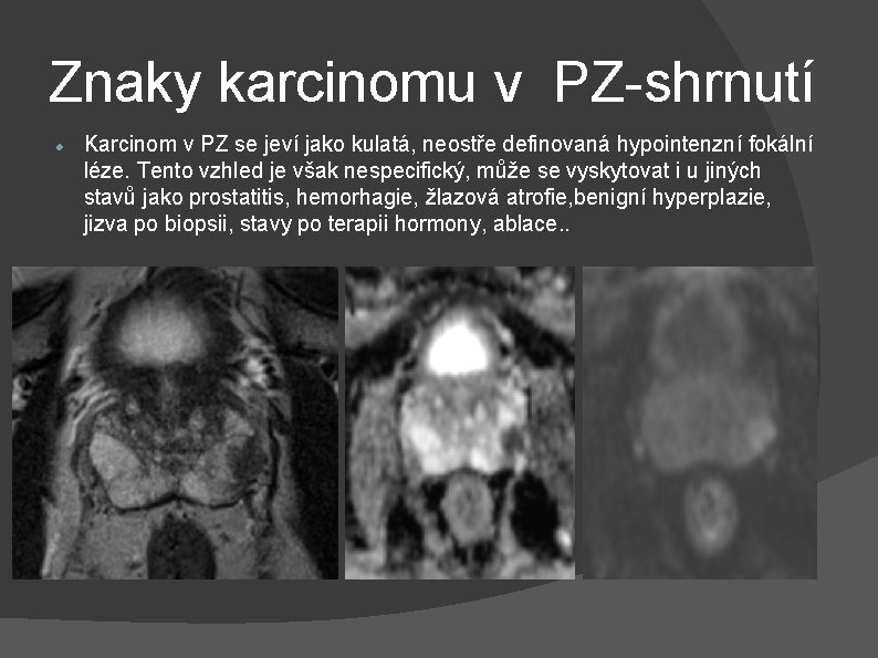 Znaky karcinomu v PZ-shrnutí Karcinom v PZ se jeví jako kulatá, neostře definovaná hypointenzní