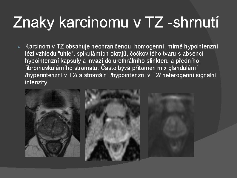 Znaky karcinomu v TZ -shrnutí Karcinom v TZ obsahuje neohraničenou, homogenní, mírně hypointenzní lézi