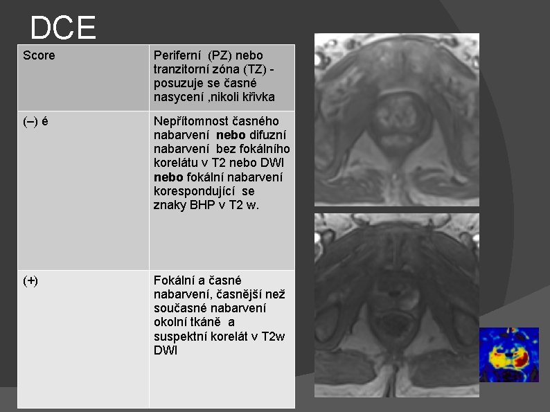 DCE Score Periferní (PZ) nebo tranzitorní zóna (TZ) posuzuje se časné nasycení , nikoli