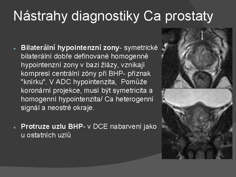 Nástrahy diagnostiky Ca prostaty Bilaterální hypointenzní zony- symetrické bilaterální dobře definované homogenně hypointenzní zony