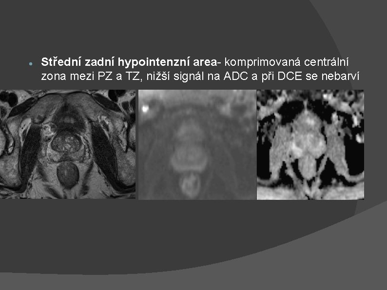  Střední zadní hypointenzní area- komprimovaná centrální zona mezi PZ a TZ, nižší signál