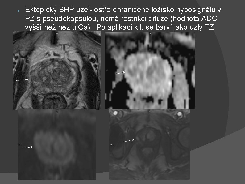  Ektopický BHP uzel- ostře ohraničené ložisko hyposignálu v PZ s pseudokapsulou, nemá restrikci