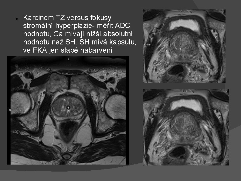  Karcinom TZ versus fokusy stromální hyperplazie- měřit ADC hodnotu, Ca mívají nižší absolutní