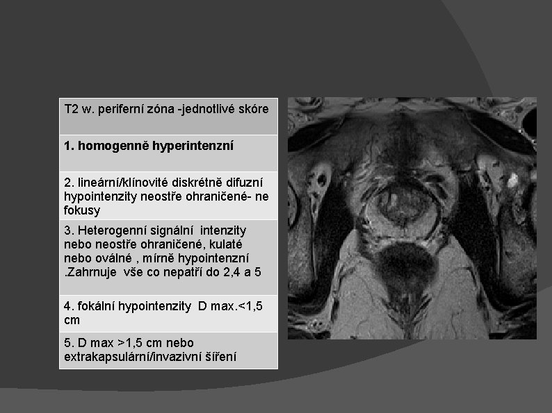 T 2 w. periferní zóna -jednotlivé skóre 1. homogenně hyperintenzní 2. lineární/klínovité diskrétně difuzní