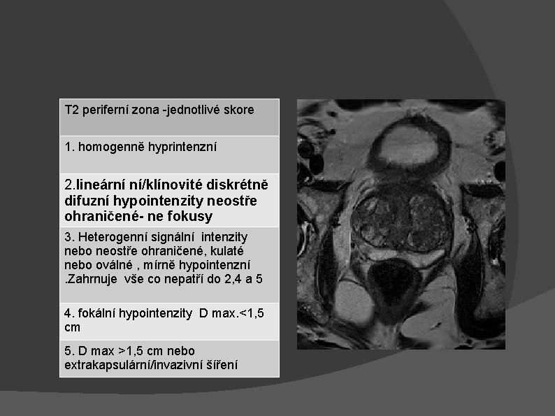 T 2 periferní zona -jednotlivé skore 1. homogenně hyprintenzní 2. lineární ní/klínovité diskrétně difuzní