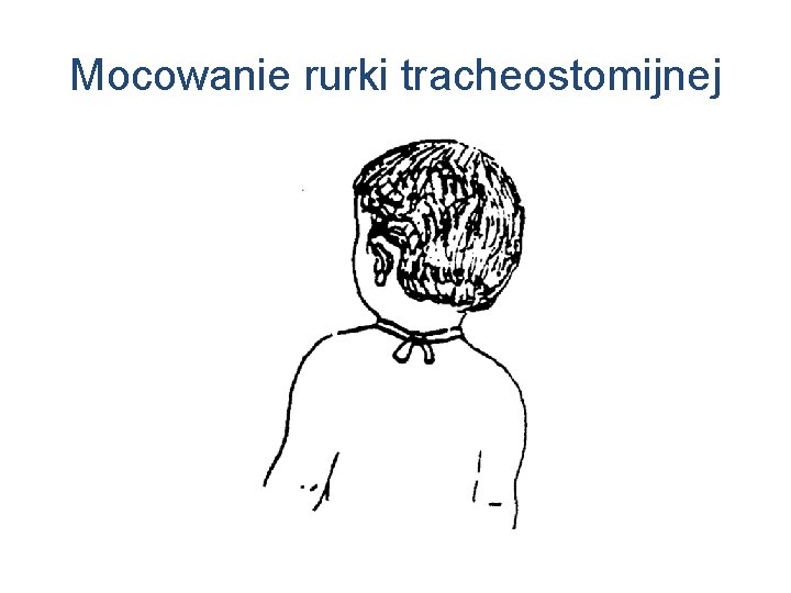 Mocowanie rurki tracheostomijnej 