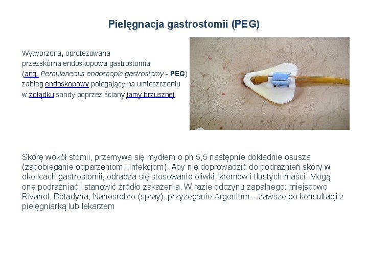 Pielęgnacja gastrostomii (PEG) Wytworzona, oprotezowana przezskórna endoskopowa gastrostomia (ang. Percutaneous endoscopic gastrostomy - PEG)