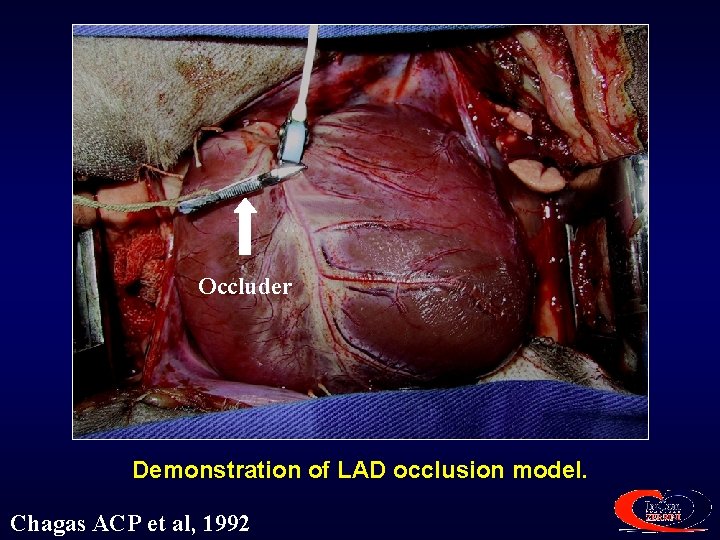 Occluder Demonstration of LAD occlusion model. Chagas ACP et al, 1992 