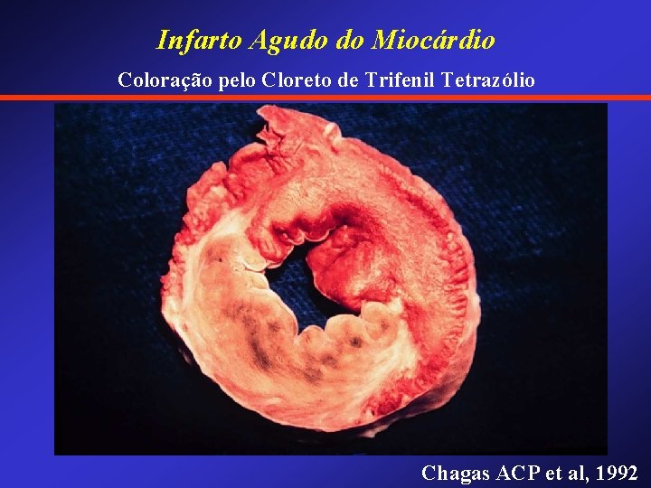 Infarto Agudo do Miocárdio Coloração pelo Cloreto de Trifenil Tetrazólio Chagas ACP et al,