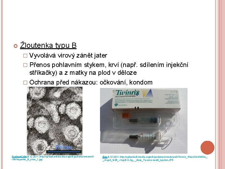  Žloutenka typu B � Vyvolává virový zánět jater � Přenos pohlavním stykem, krví