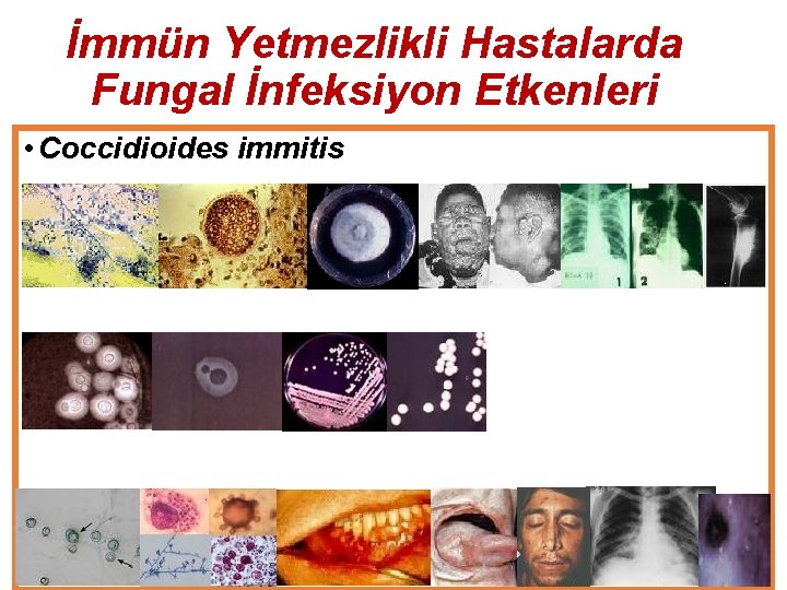 İmmün Yetmezlikli Hastalarda Fungal İnfeksiyon Etkenleri • Coccidioides immitis • Crytococcus neoformans (meningitis) •