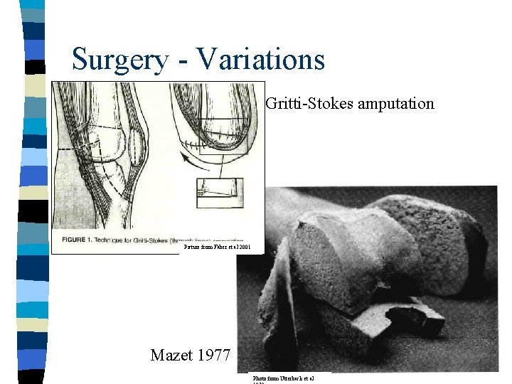 Surgery - Variations Gritti-Stokes amputation Picture from Faber et al 2001 Mazet 1977 Photo