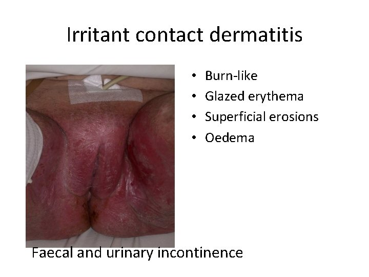 Irritant contact dermatitis • • Burn-like Glazed erythema Superficial erosions Oedema Faecal and urinary