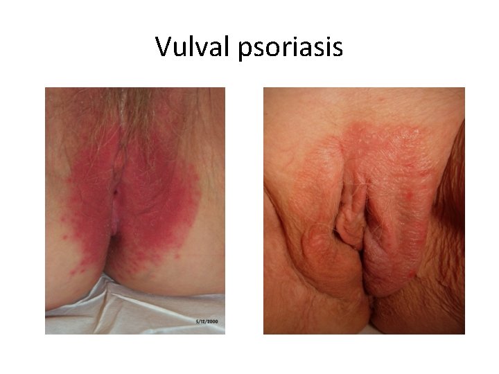 Vulval psoriasis 