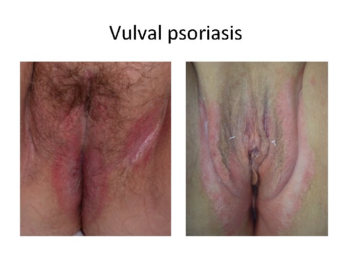 Vulval psoriasis 