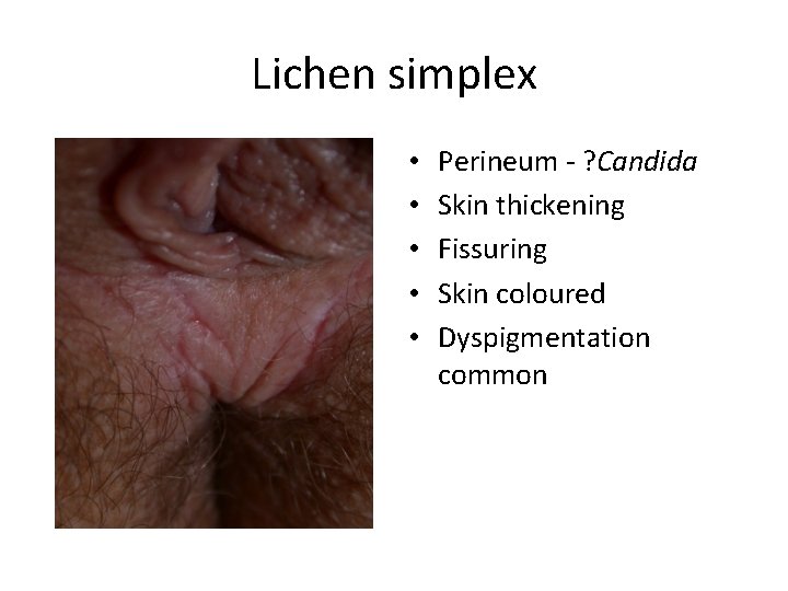 Lichen simplex • • • Perineum - ? Candida Skin thickening Fissuring Skin coloured
