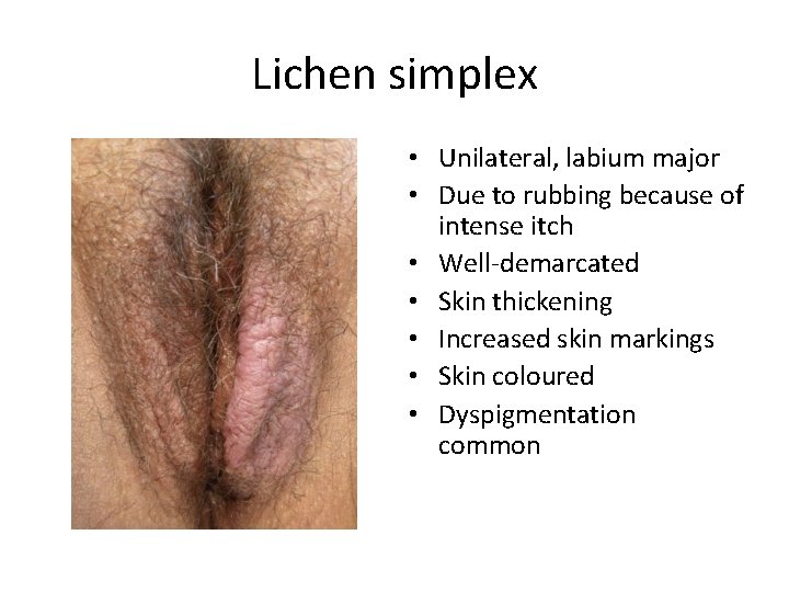 Lichen simplex • Unilateral, labium major • Due to rubbing because of intense itch
