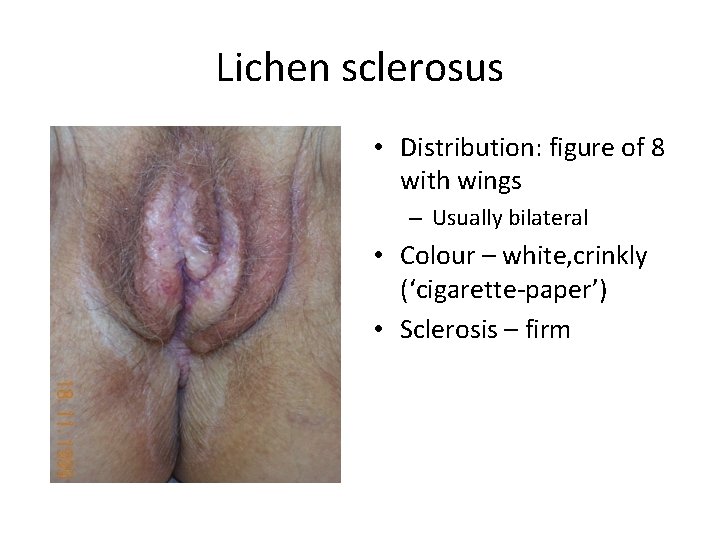 Lichen sclerosus • Distribution: figure of 8 with wings – Usually bilateral • Colour