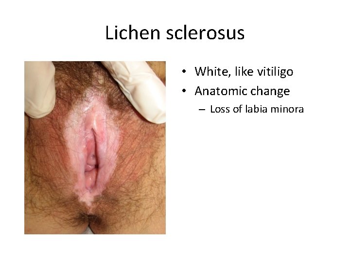 Lichen sclerosus • White, like vitiligo • Anatomic change – Loss of labia minora