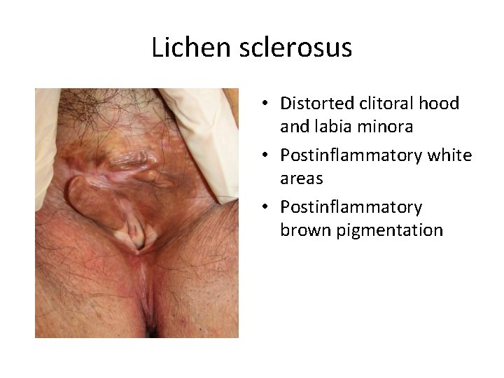 Lichen sclerosus • Distorted clitoral hood and labia minora • Postinflammatory white areas •