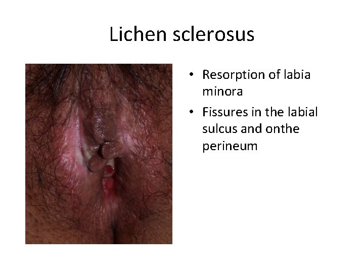 Lichen sclerosus • Resorption of labia minora • Fissures in the labial sulcus and