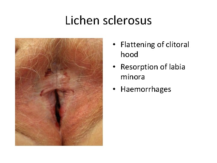 Lichen sclerosus • Flattening of clitoral hood • Resorption of labia minora • Haemorrhages