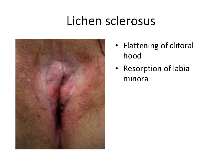 Lichen sclerosus • Flattening of clitoral hood • Resorption of labia minora 