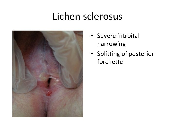 Lichen sclerosus • Severe introital narrowing • Splitting of posterior forchette 