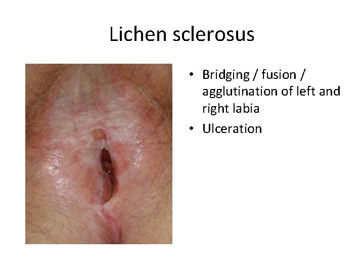 Lichen sclerosus • Bridging / fusion / agglutination of left and right labia •