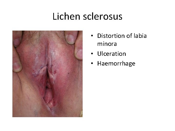 Lichen sclerosus • Distortion of labia minora • Ulceration • Haemorrhage 