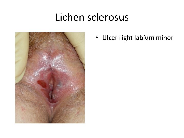 Lichen sclerosus • Ulcer right labium minor 